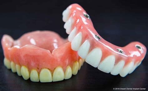 Its your turn now to enjoy your smile and transform your life. . Affordable dentures and implants